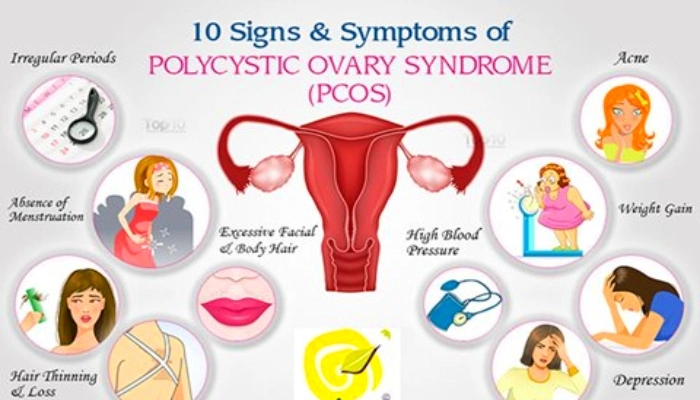 PCOS 