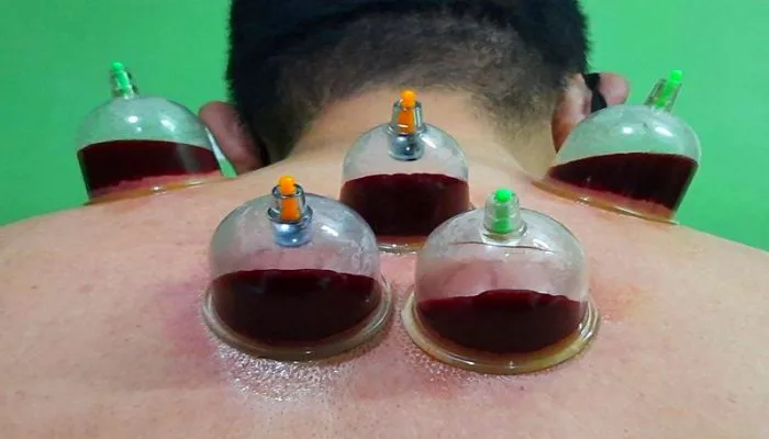 cupping-therapy   