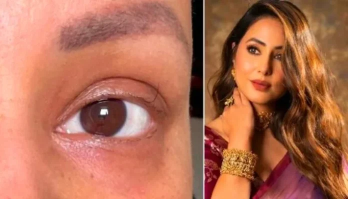 hina-khan-shares-post-losing-her-eyelashes-due-to-chemotherapy